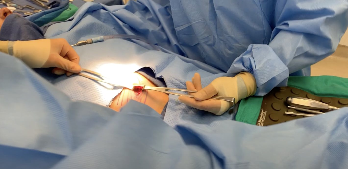 Rib Graft for Rhinoplasty Part 4