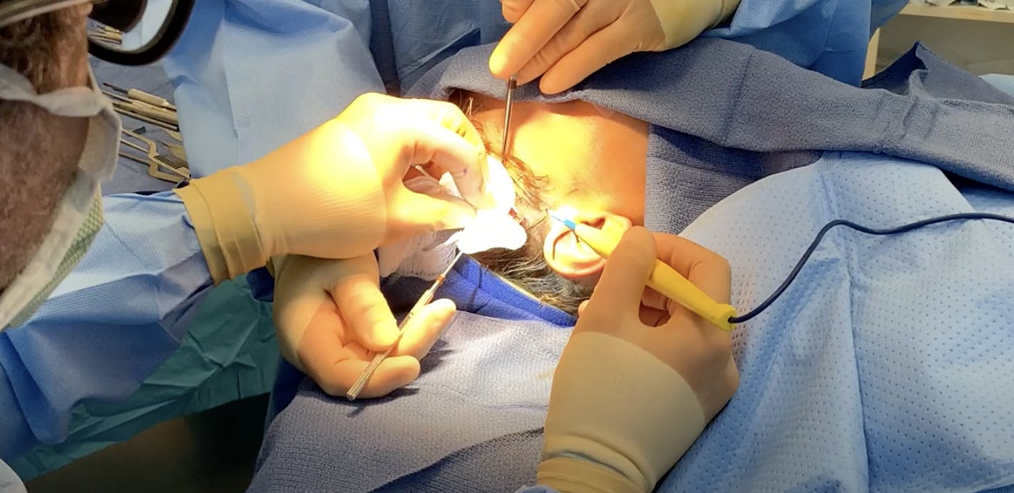 Rib Graft for Rhinoplasty Part 5