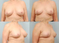 Breast Implant Removal Before & After Gallery - Patient 422760 - Image 1