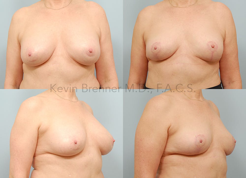Breast Lift Before & After Gallery - Patient 184911 - Image 1