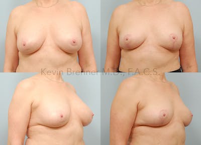 Breast Implant Removal Before & After Gallery - Patient 422760 - Image 1