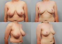 Before and after breast reduction by Dr. Brenner.