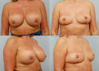 Breast Lift Before & After Gallery - Patient 146209641 - Image 1