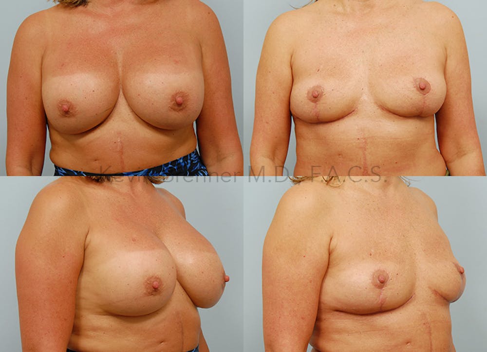 Breast Lift Before & After Gallery - Patient 146209641 - Image 1