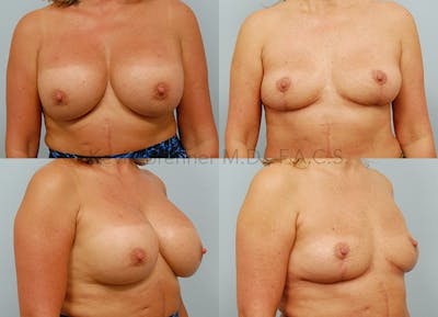 Breast Implant Removal Before & After Gallery - Patient 146209647 - Image 1