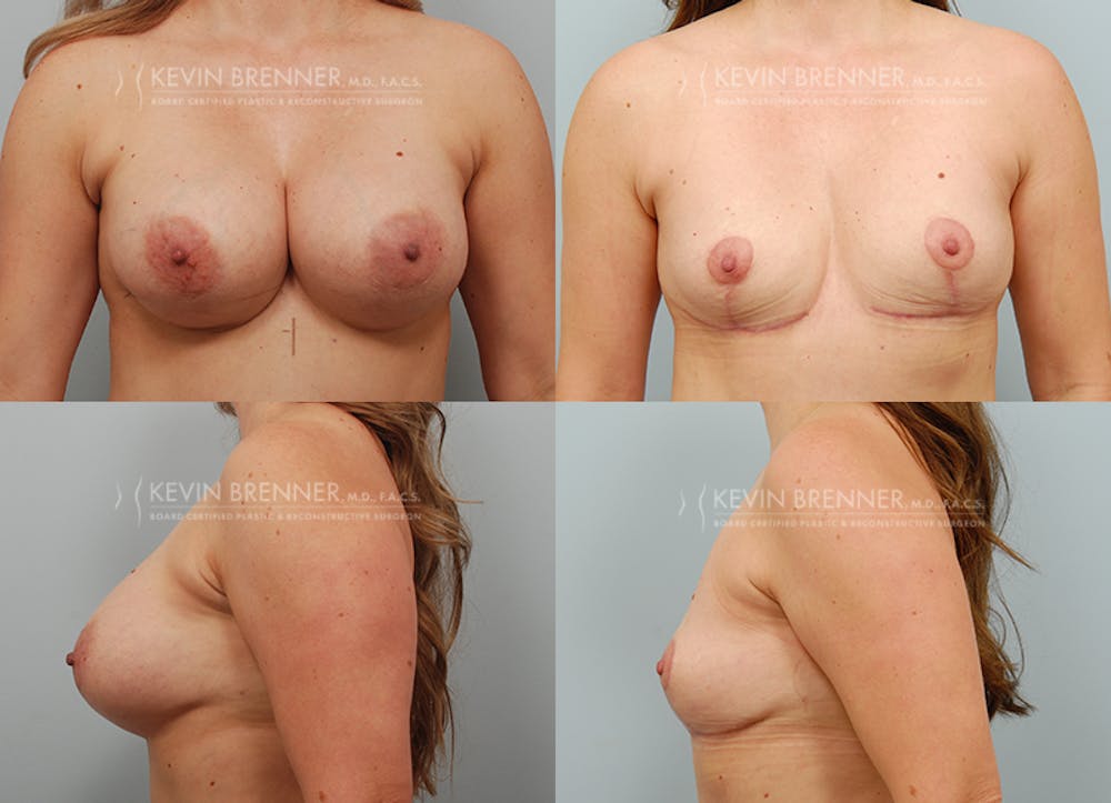 Breast Lift Before & After Gallery - Patient 307833 - Image 1