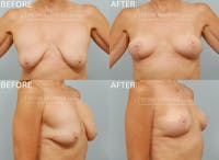 Breast Lift Before & After Gallery - Patient 400913 - Image 1
