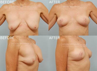 Breast Lift Before & After Gallery - Patient 400913 - Image 1
