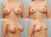 Breast Implant Removal Before & After Gallery - Patient 200839 - Image 1