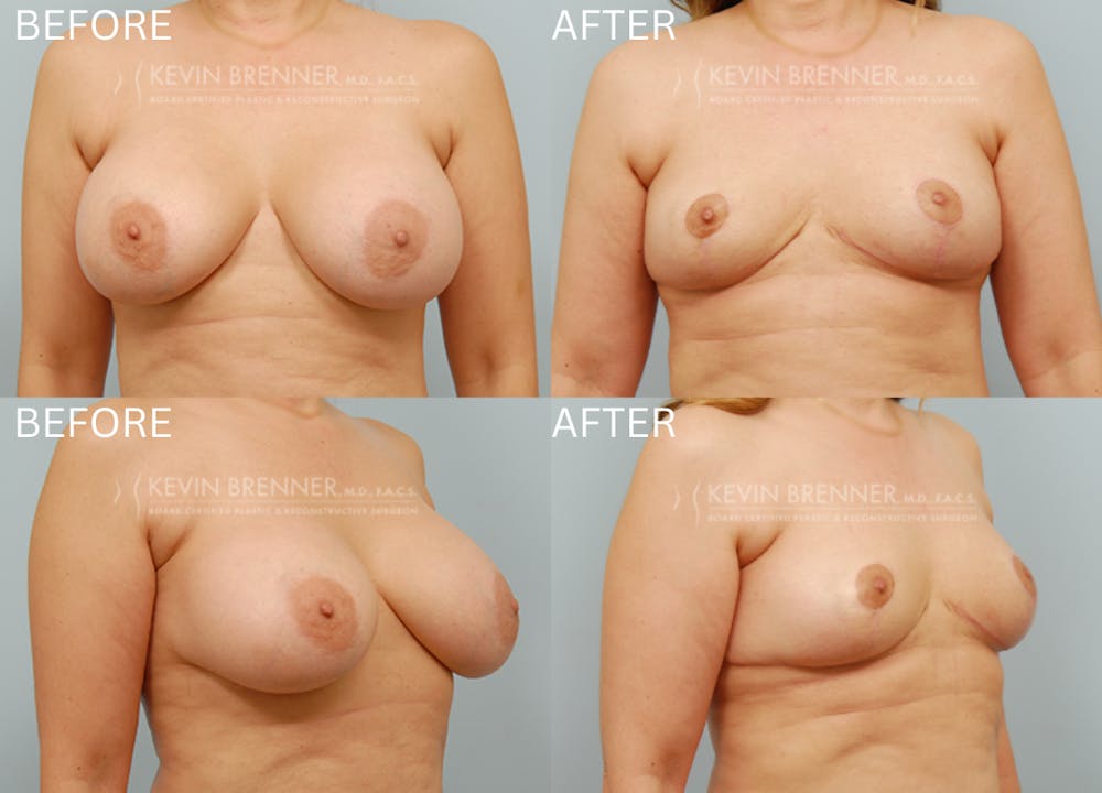 Breast Implant Removal Before & After Gallery - Patient 200839 - Image 1