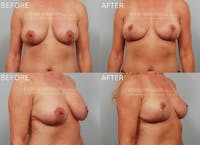 Breast Implant Removal Before & After Gallery - Patient 140542 - Image 1