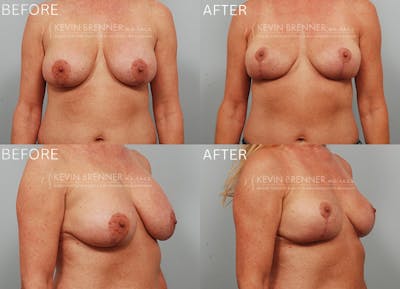 Breast Implant Removal Before & After Gallery - Patient 140542 - Image 1