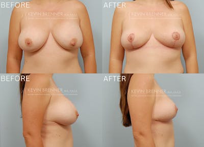 Breast Implant Removal Before & After Gallery - Patient 694257 - Image 1
