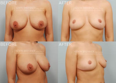 Breast Implant Removal Before & After Gallery - Patient 595723 - Image 1