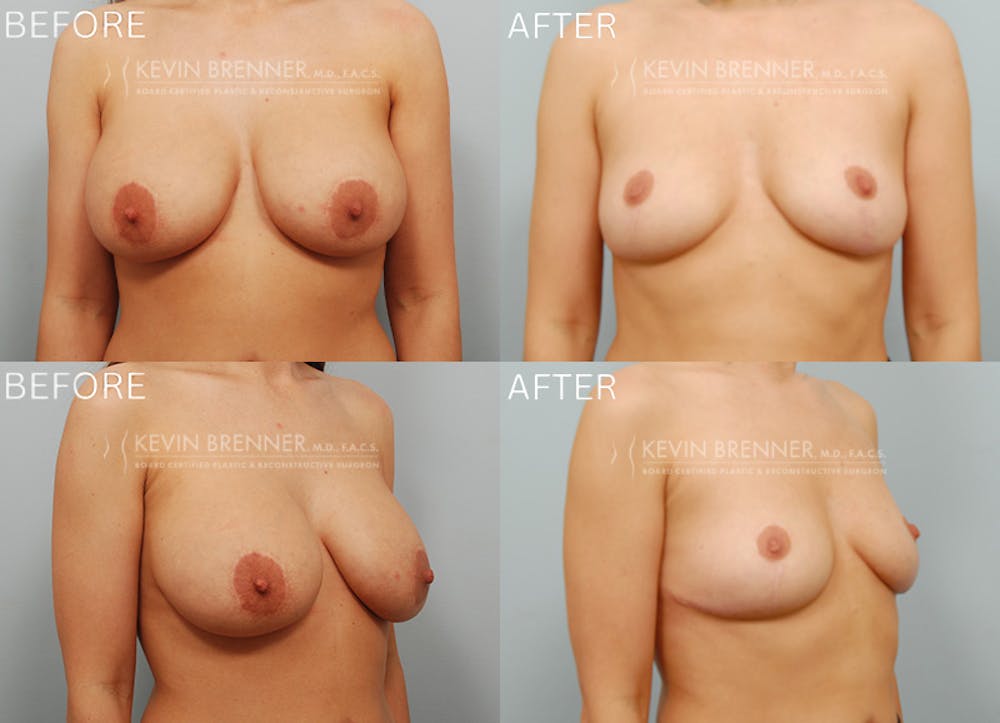 Breast Implant Removal Before & After Gallery - Patient 595723 - Image 1