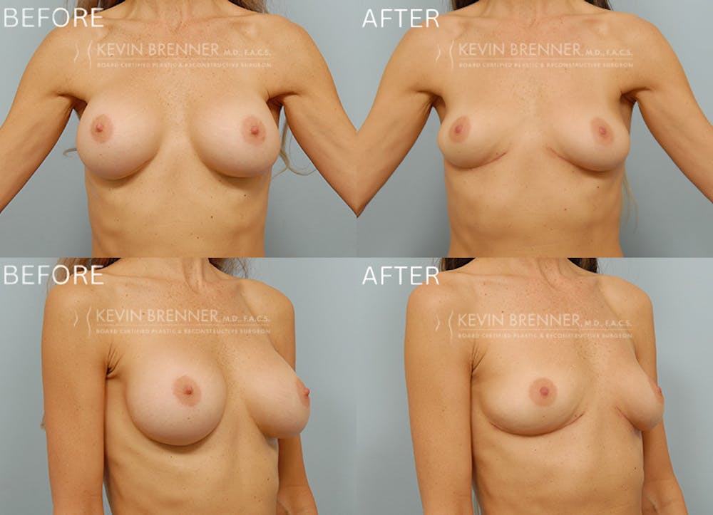 Breast Implant Removal without Lift Before & After Gallery - Patient 179324 - Image 1