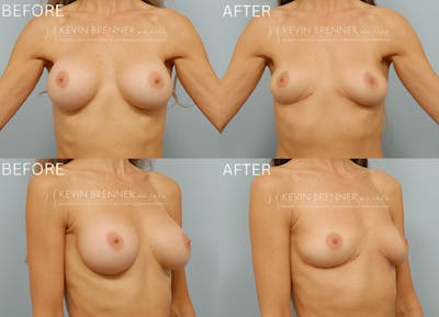 Breast Implant Removal without Lift Before & After Gallery - Patient 179324 - Image 1