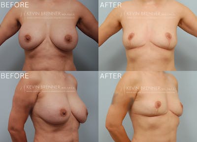 Breast Implant Removal Before & After Gallery - Patient 175411 - Image 1