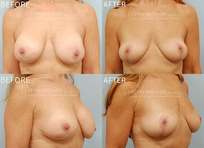 Breast Implant Removal Before & After Gallery - Patient 151005 - Image 1