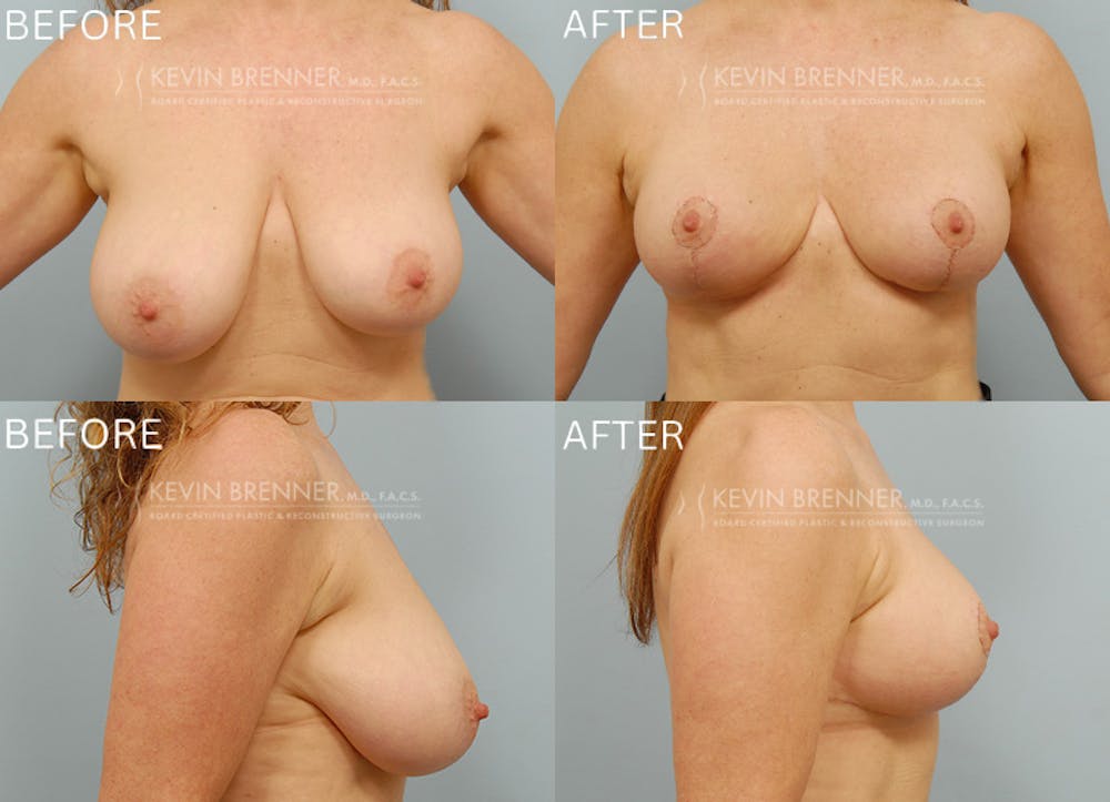 Breast Lift Before & After Gallery - Patient 249983 - Image 1