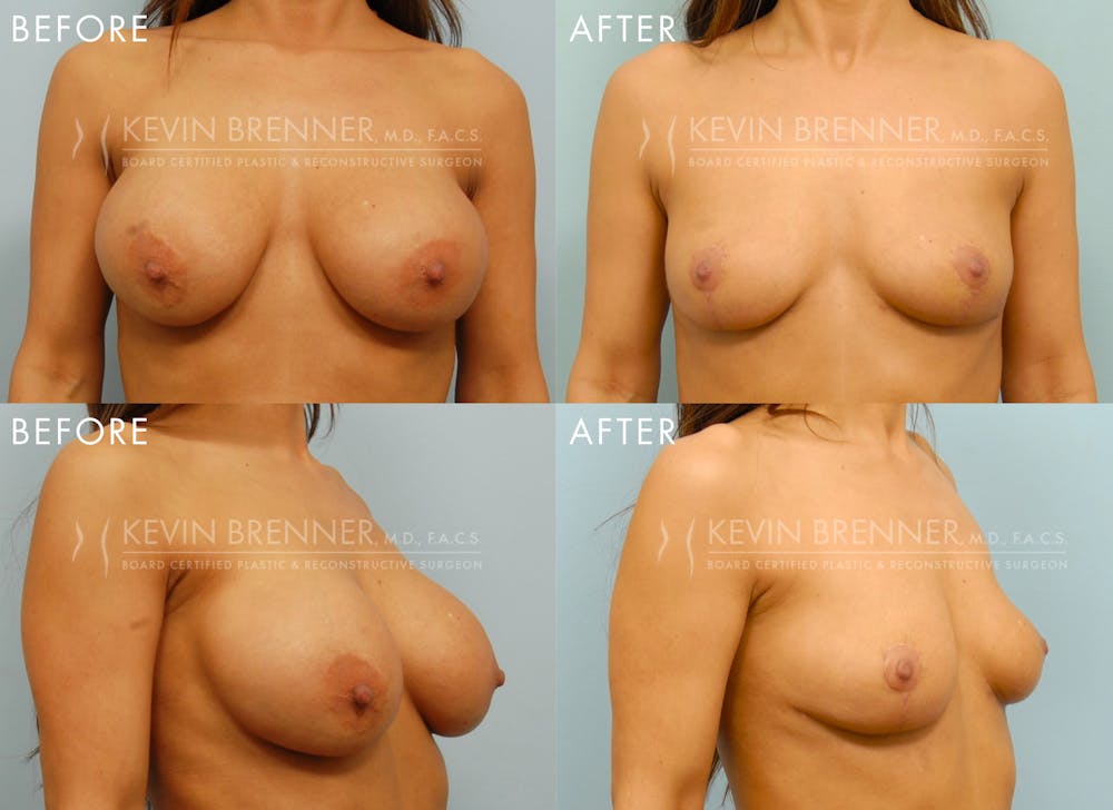 Breast Implant Removal with Lift Before & After Gallery - Patient 236783 - Image 1