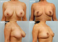 Breast Implant Removal with Lift Before & After Gallery - Patient 236276 - Image 1