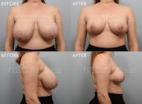 Breast Reduction Before & After Gallery - Patient 151850 - Image 1