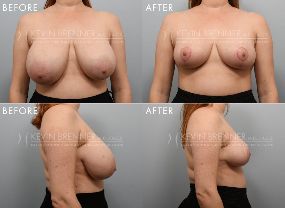 Breast Reduction Before & After Gallery - Patient 151850 - Image 1