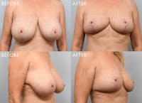 Breast Reduction Before & After Gallery - Patient 133863 - Image 1