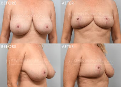 Breast Reduction Before & After Gallery - Patient 133863 - Image 1