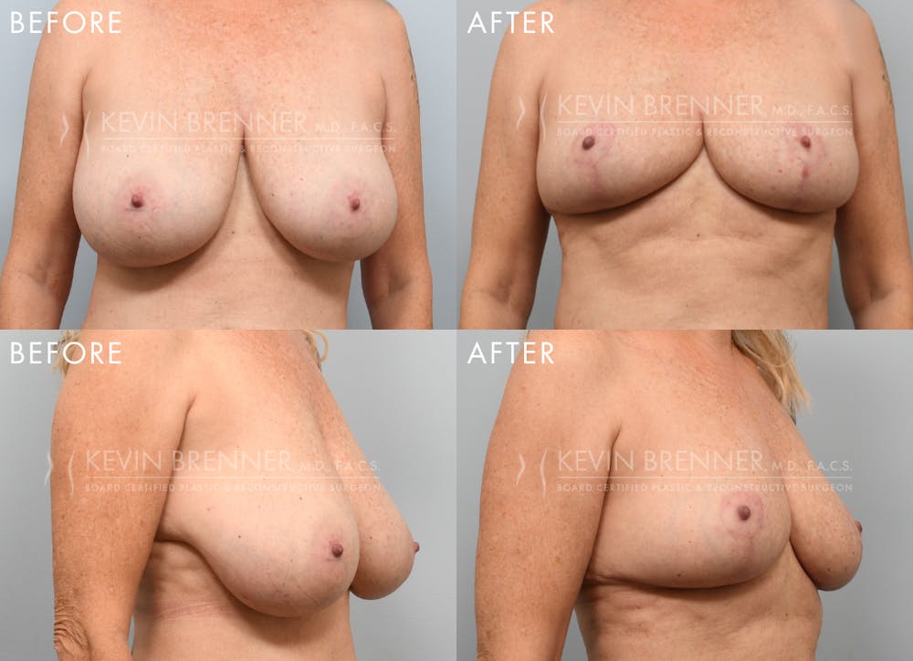 Breast Reduction Before & After Gallery - Patient 133863 - Image 1