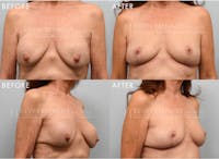 Breast Implant Removal with Lift Before & After Gallery - Patient 192994 - Image 1