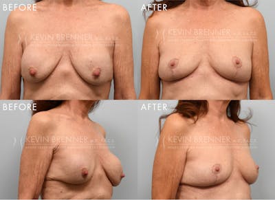 Breast Implant Removal with Lift Before & After Gallery - Patient 192994 - Image 1