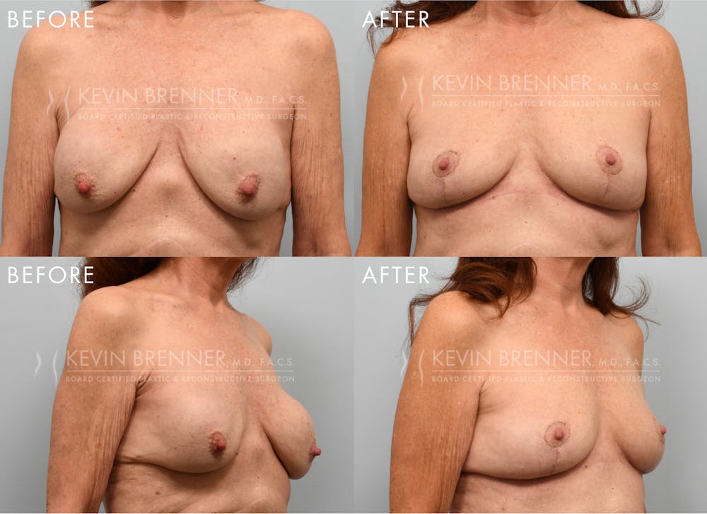 Breast Implant Removal with Lift Before & After Gallery - Patient 192994 - Image 1