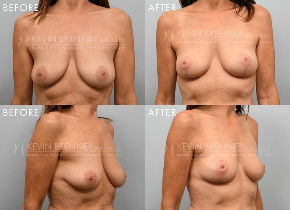 Breast Lift Before & After Gallery - Patient 394824 - Image 1