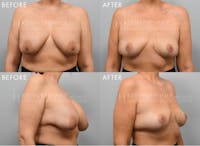 Breast Implant Removal with Lift Before & After Gallery - Patient 404561 - Image 1