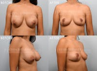 Breast Implant Removal with Lift Before & After Gallery - Patient 249169 - Image 1