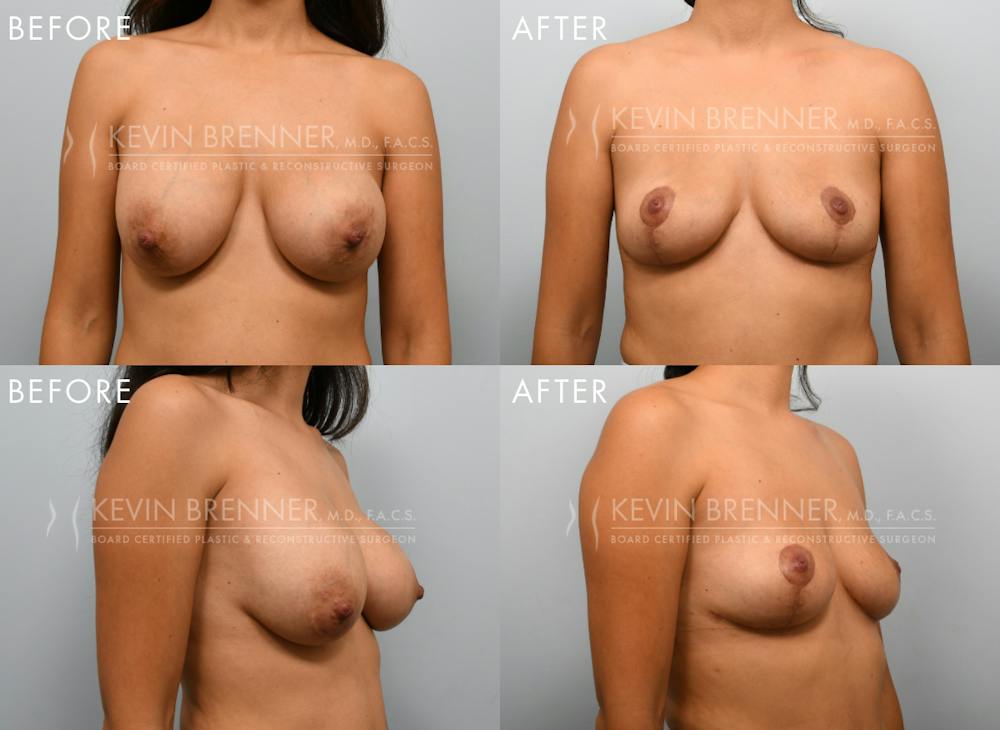Breast Implant Removal with Lift Before & After Gallery - Patient 249169 - Image 1