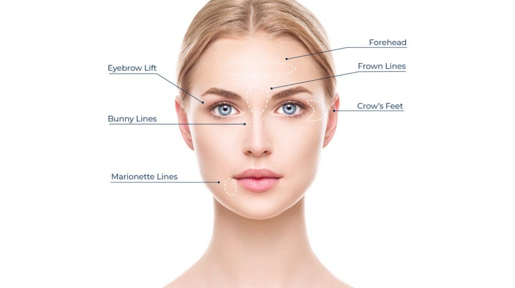 botox infographic