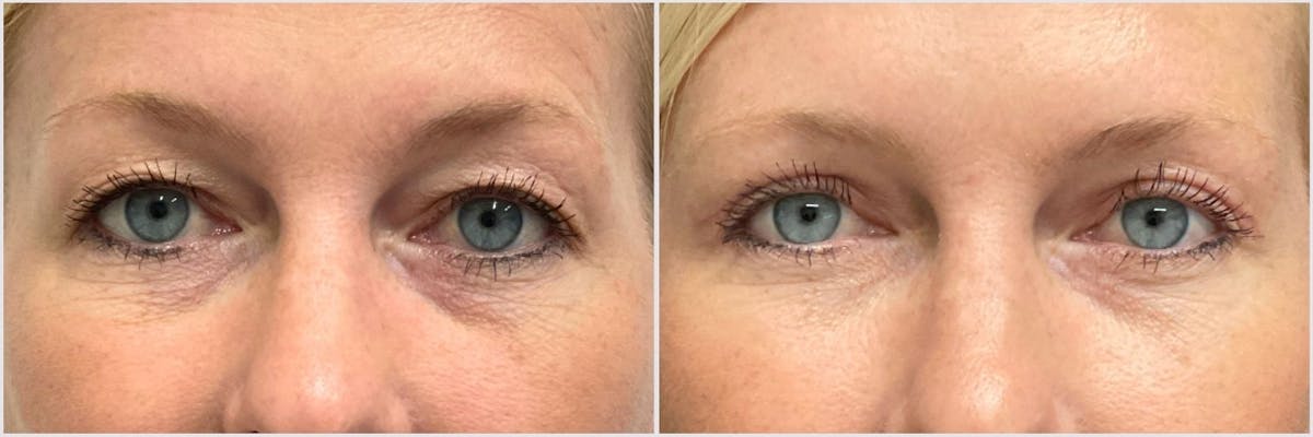 Upper Blepharoplasty Before & After Gallery - Patient 146521 - Image 1