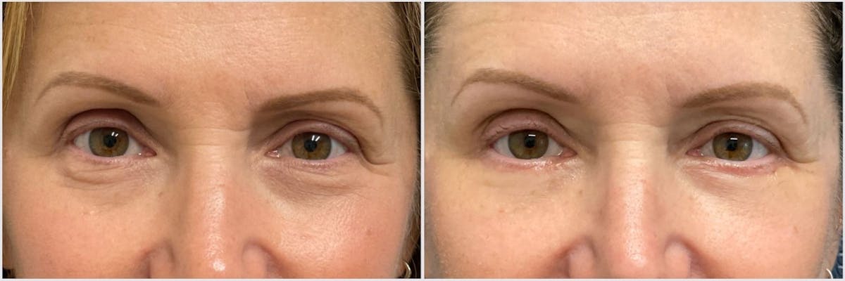 Lower Blepharoplasty Before & After Gallery - Patient 282195 - Image 1