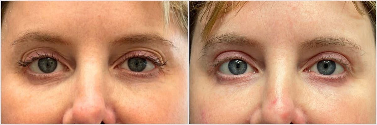 Upper Blepharoplasty Before & After Gallery - Patient 399513 - Image 1