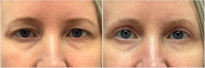 Upper Blepharoplasty Before & After Gallery - Patient 133639 - Image 1