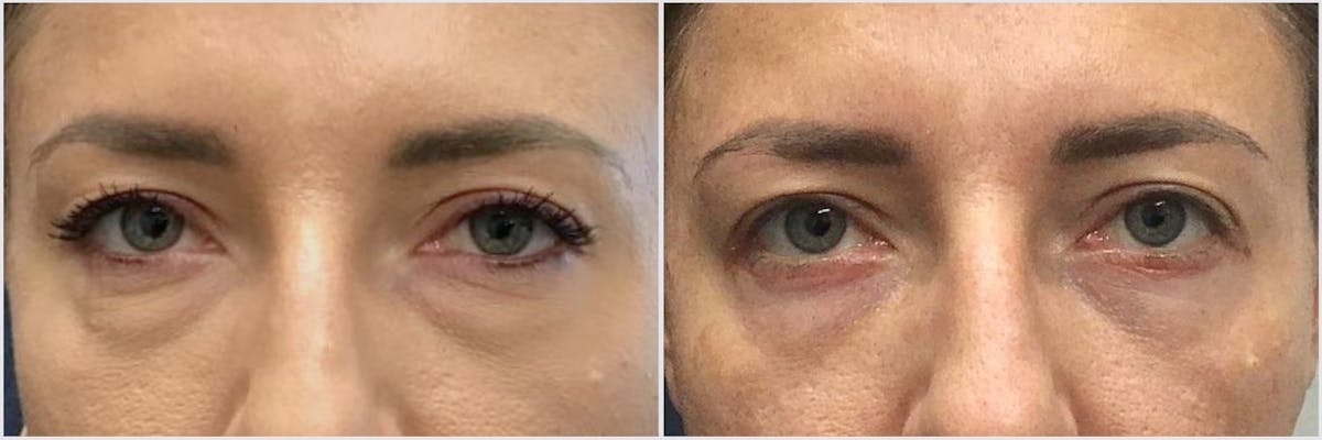Lower Blepharoplasty Before & After Gallery - Patient 229645 - Image 1