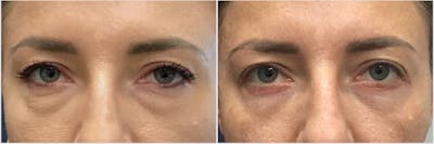 Lower Blepharoplasty Before & After Gallery - Patient 229645 - Image 1