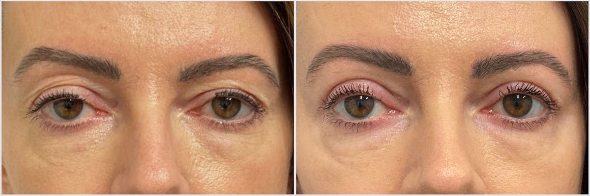 Upper Blepharoplasty Before & After Gallery - Patient 286686 - Image 1