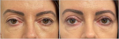 Upper Blepharoplasty Before & After Gallery - Patient 286686 - Image 1