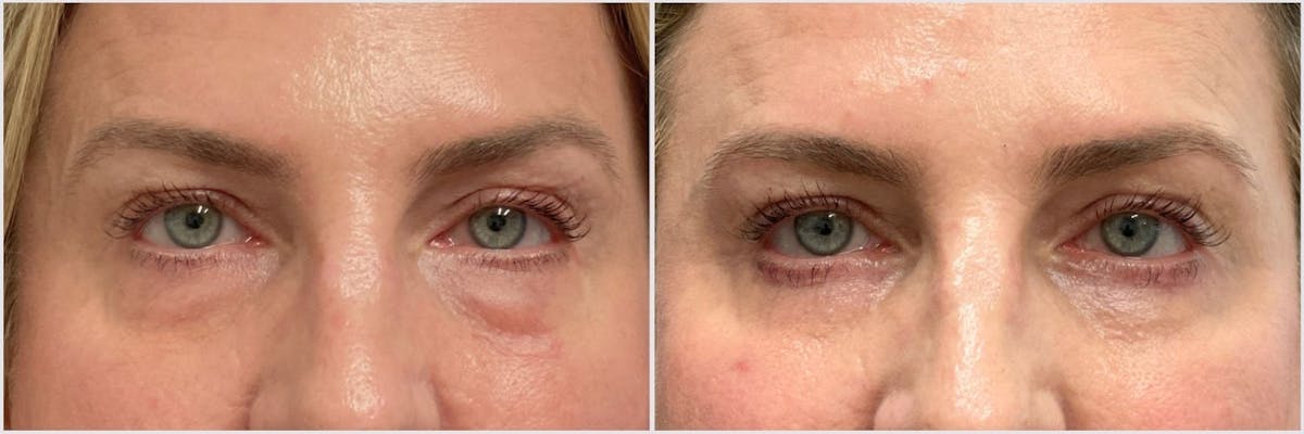 Lower Blepharoplasty Before & After Gallery - Patient 583215 - Image 1