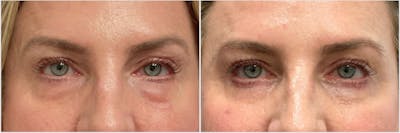 Lower Blepharoplasty Before & After Gallery - Patient 583215 - Image 1