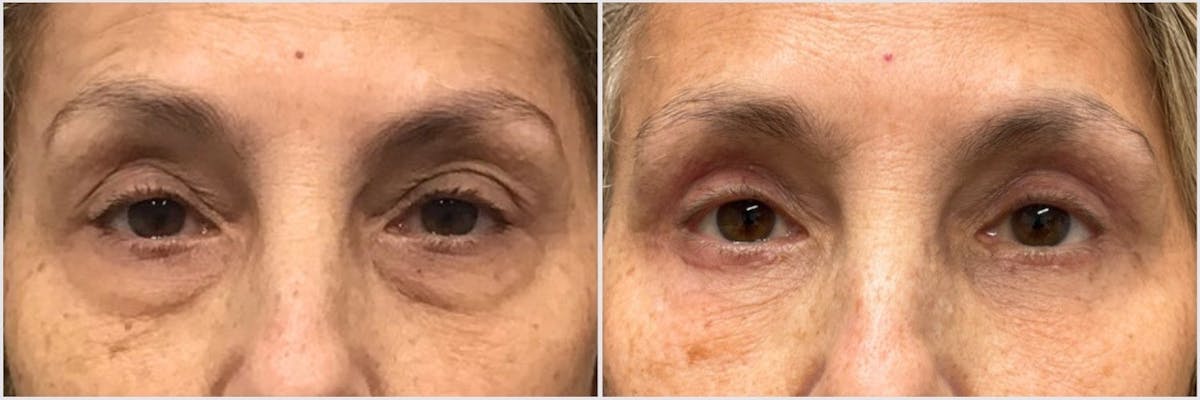 Upper & Lower Blepharoplasty Before & After Gallery - Patient 261749 - Image 1